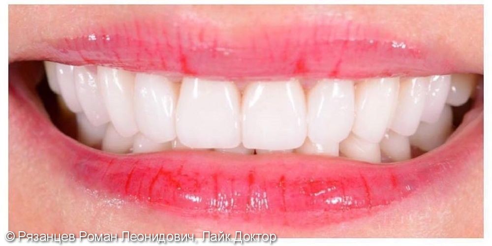Форма и цвет зубов - это то, что чаще всего просят изменить пациенты. - фото №2
