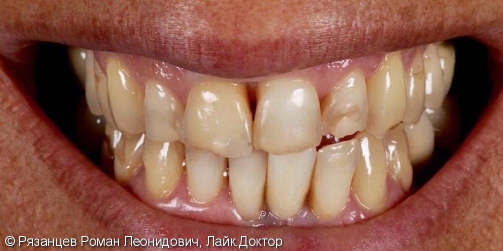 Исправить эстетические несовершенства зубного ряда - фото №1