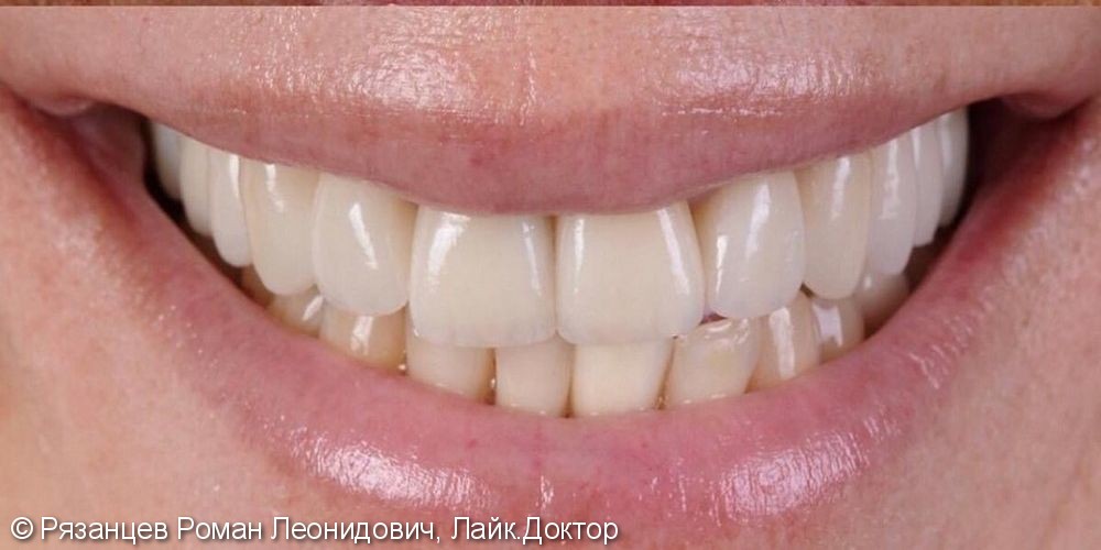 Исправить эстетические несовершенства зубного ряда - фото №2