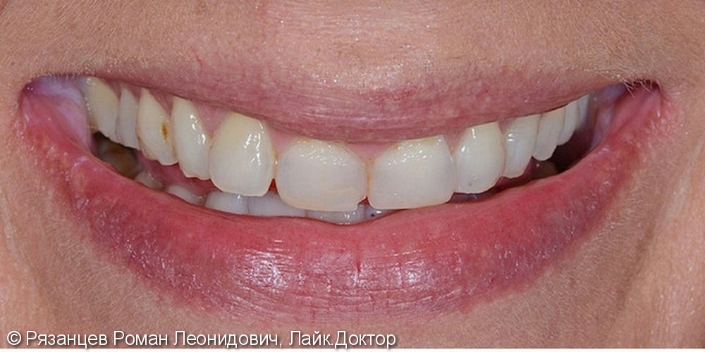 Наиболее частая причина обращения к стоматологу для эстетического преображения – недовольство формой и цветом своих зубов. - фото №1