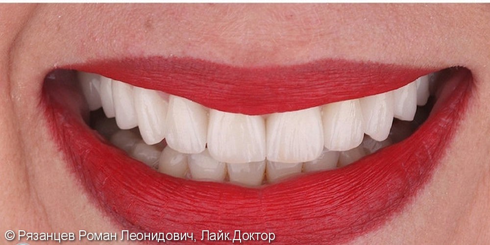 Наиболее частая причина обращения к стоматологу для эстетического преображения – недовольство формой и цветом своих зубов. - фото №2