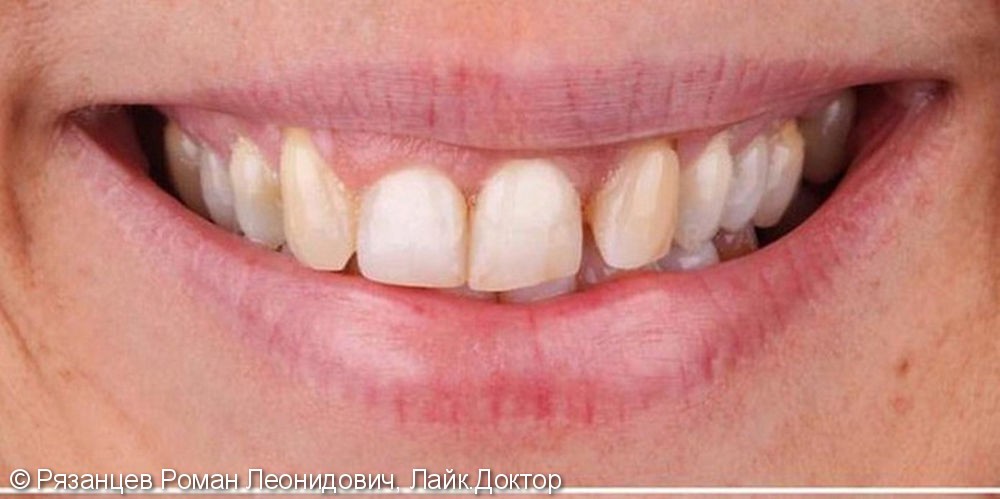 Результат установки керамических виниров на передние зубы - фото №1