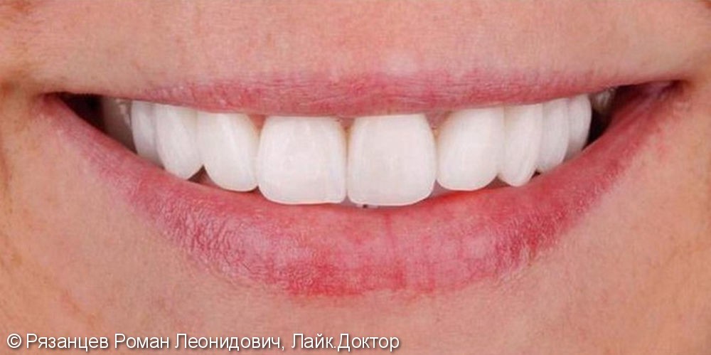 Результат установки керамических виниров на передние зубы - фото №2