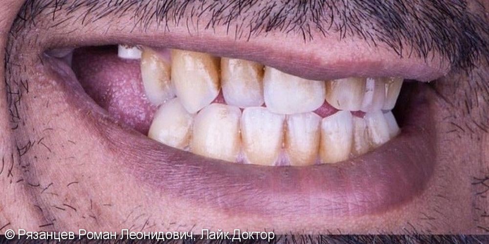 Частичная потеря зубов, скученность зубного ряда, многочисленные зубные отложения, разрушенная эмаль зубов с многочисленными кариозными процессами - все это было было обнаружено у пациента при первом осмотре - фото №1