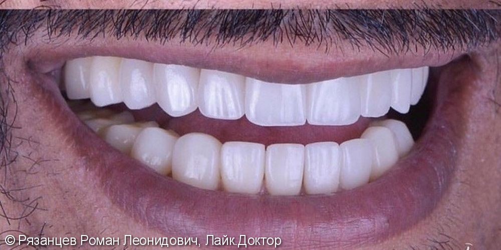 Частичная потеря зубов, скученность зубного ряда, многочисленные зубные отложения, разрушенная эмаль зубов с многочисленными кариозными процессами - все это было было обнаружено у пациента при первом осмотре - фото №2