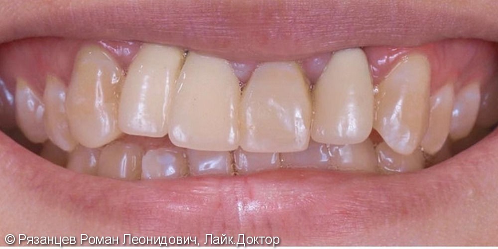 Комбинируем разные виды стоматологических конструкций: керамические виниры и коронки на диоксиде циркония - фото №1