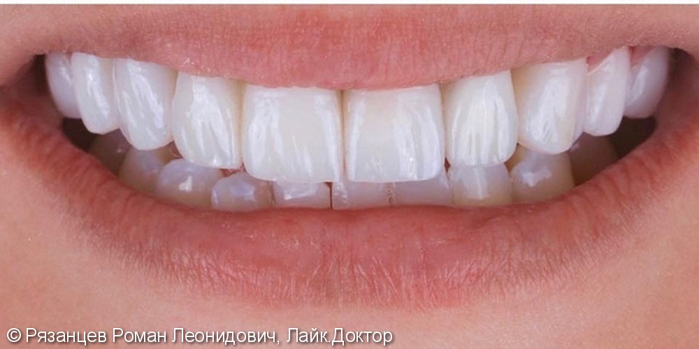 Комбинируем разные виды стоматологических конструкций: керамические виниры и коронки на диоксиде циркония - фото №2