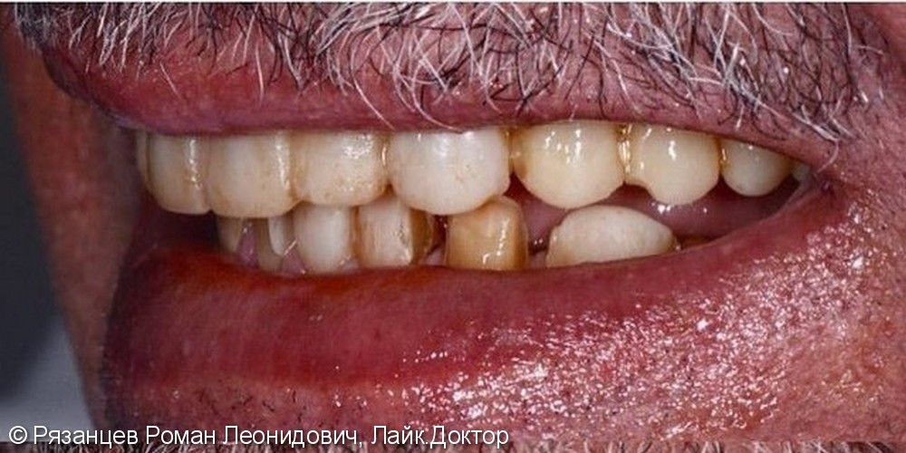 Вредные привычки, композитные реставрации, старые ортопедические конструкции изменили зубы пациента до неузнаваемости - фото №1