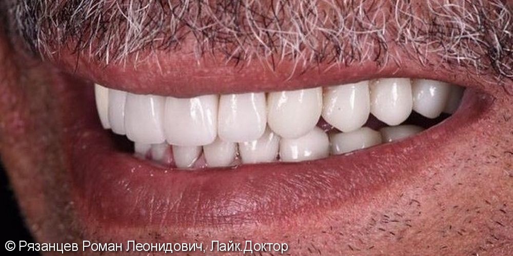 Вредные привычки, композитные реставрации, старые ортопедические конструкции изменили зубы пациента до неузнаваемости - фото №2
