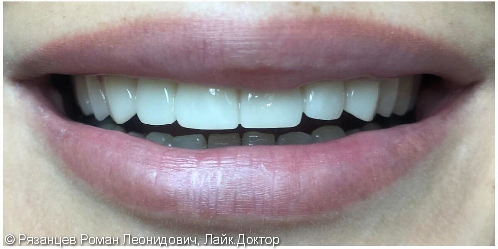 Задача: исправить непривлекательную форму и цвет зубов - фото №2