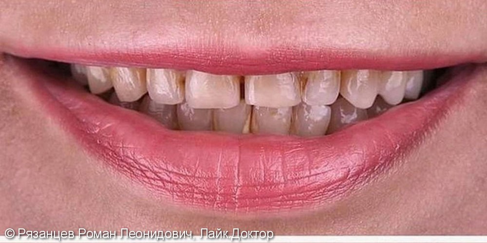 Низкая коронковая часть зуба, сероватый оттенок зубов и общее недовольство своей улыбкой/ - фото №1