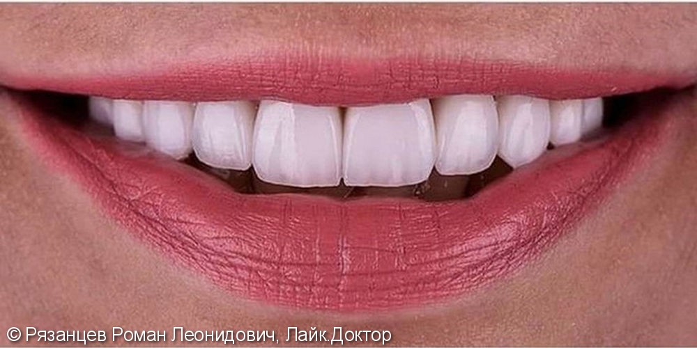 Низкая коронковая часть зуба, сероватый оттенок зубов и общее недовольство своей улыбкой/ - фото №2