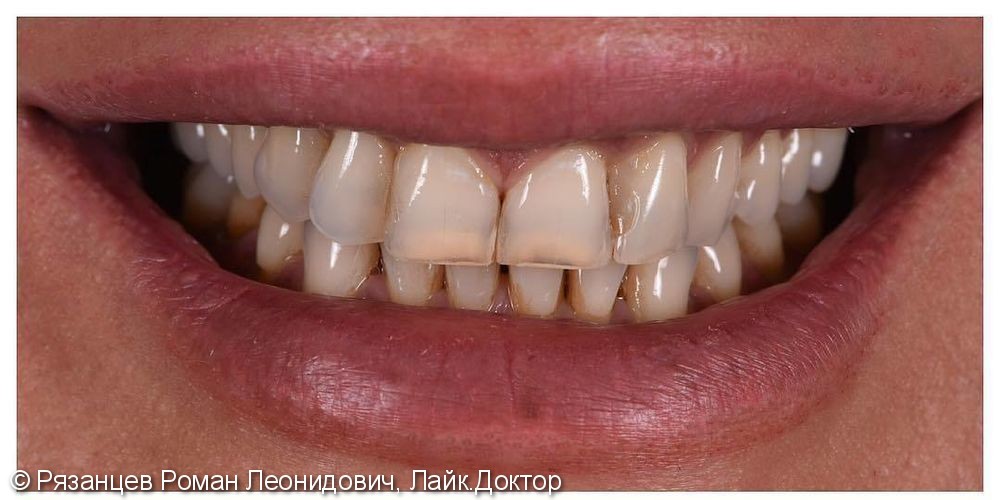 Проблему видно сразу - цвет и недостатки формы зубов. В мечтах пациента - красивая улыбка, белые зубы идеальной формы. ⠀ - фото №1