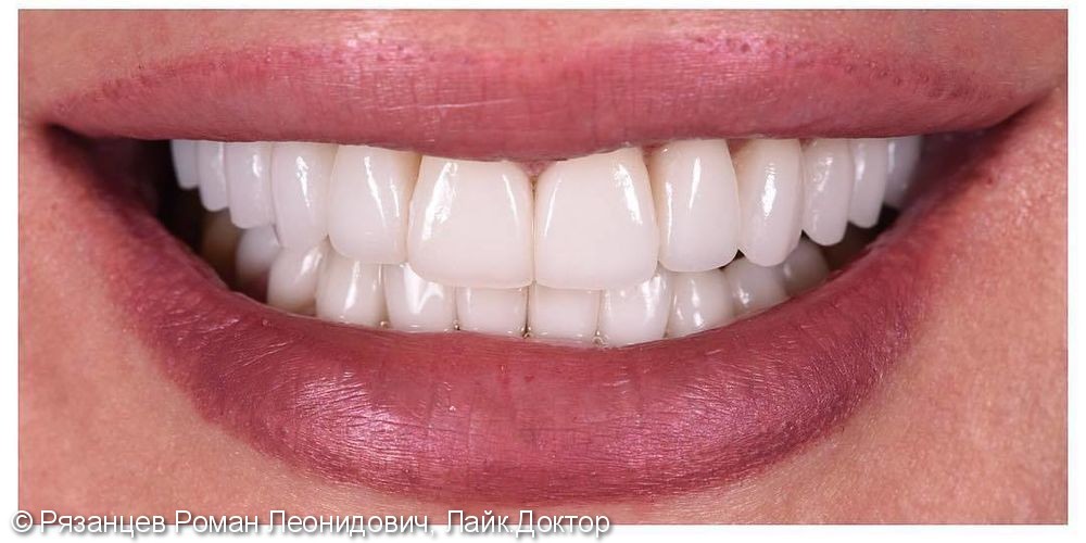 Проблему видно сразу - цвет и недостатки формы зубов. В мечтах пациента - красивая улыбка, белые зубы идеальной формы. ⠀ - фото №2