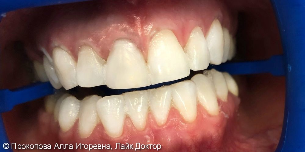 Результат отбеливания зубов ZOOM4 - фото №2