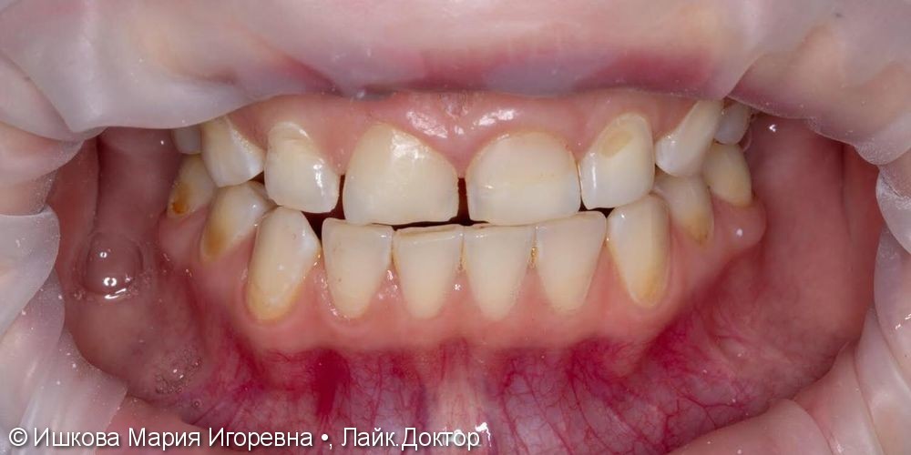 Реставрация зуба - фото №2