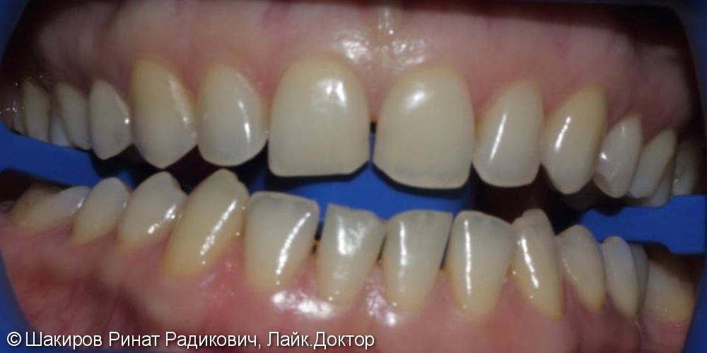 Результат отбеливания зубов ZOOM - фото №1