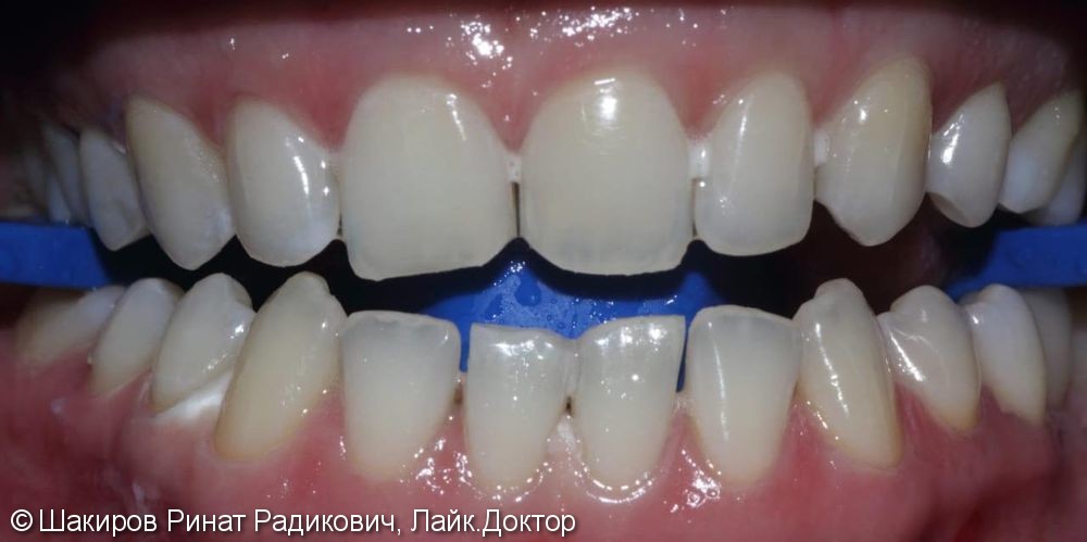 Результат отбеливания зубов ZOOM - фото №2