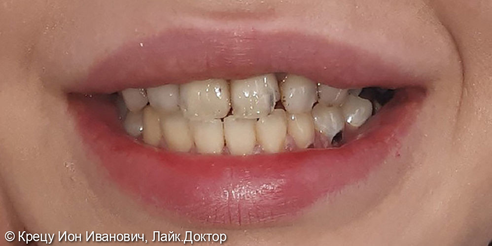 Восстановление зубов с помощью металлокерамических коронок - фото №1