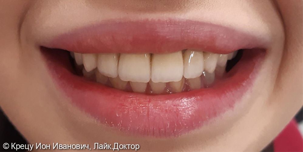 Восстановление зубов с помощью металлокерамических коронок - фото №2