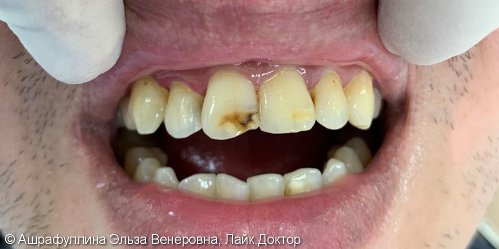 Реставрация центральных зубов верхней челюсти - фото №1
