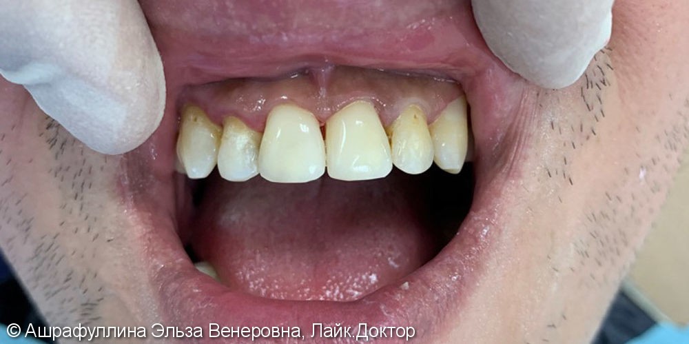 Реставрация центральных зубов верхней челюсти - фото №2