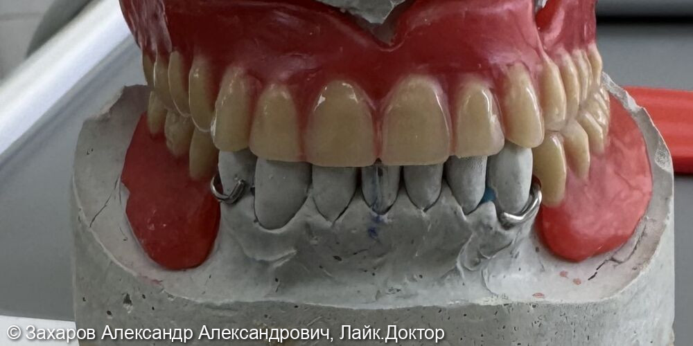 Протезирование с опорой на зубы - фото №1
