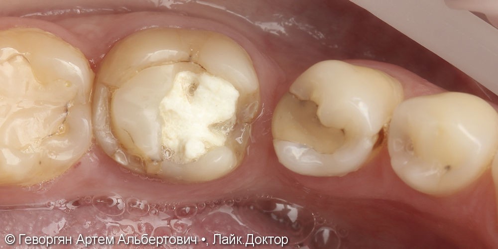 Восстановление двух жевательных зубов керамическими накладками - фото №1