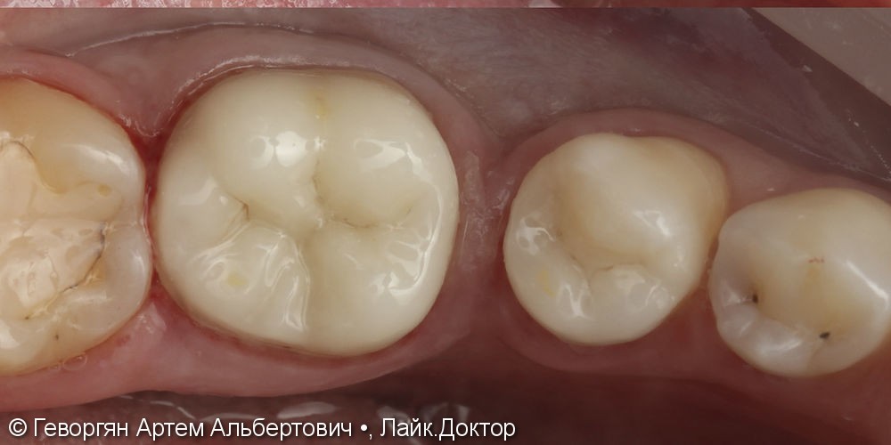 Восстановление двух жевательных зубов керамическими накладками - фото №2