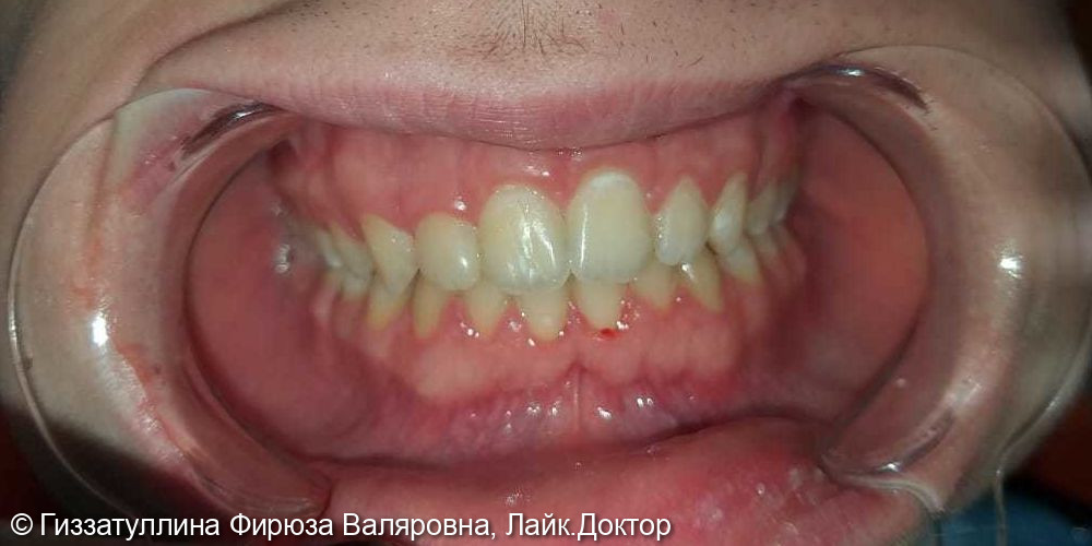 Исправление положения зубов в челюсти с помощью брекет системы - фото №2
