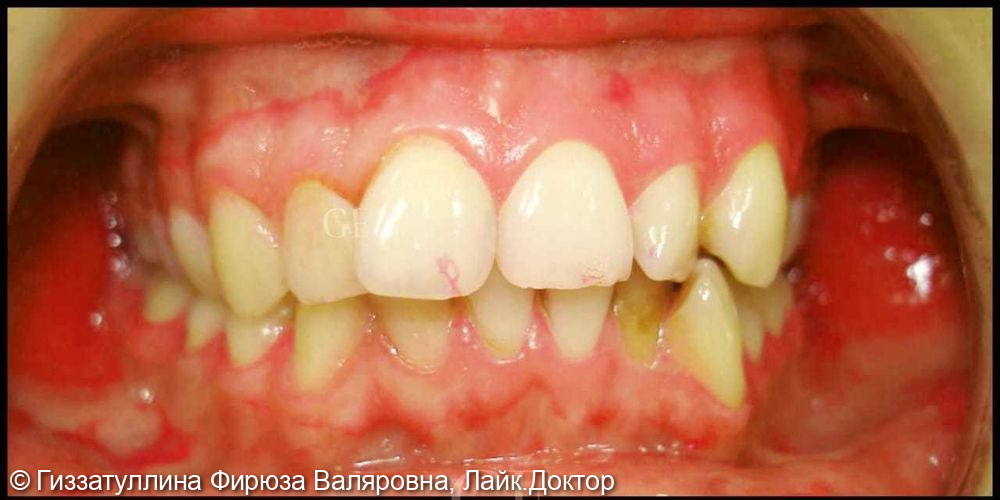 Исправление положения зубов в челюсти с помощью брекет системы - фото №1