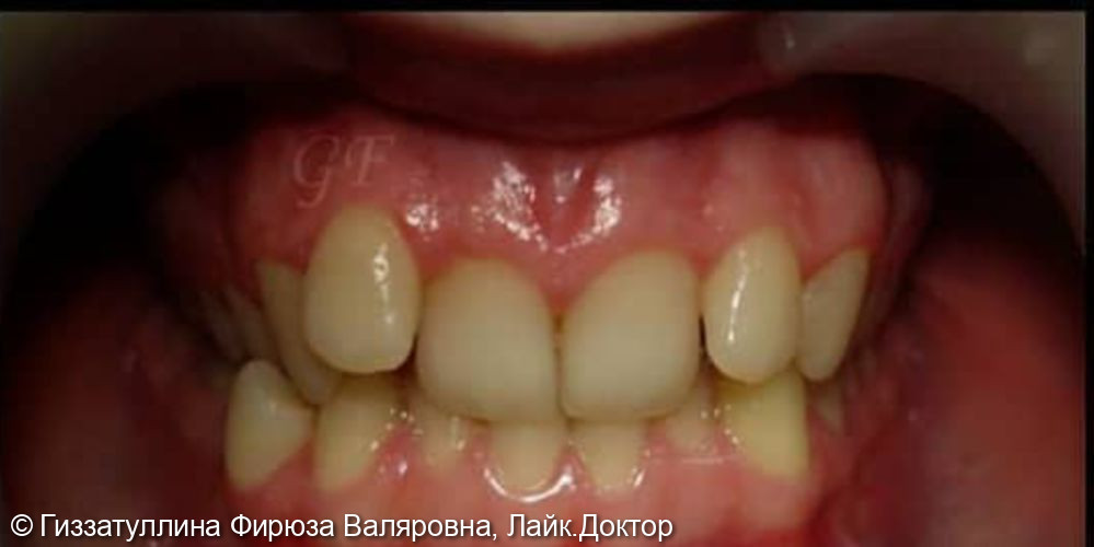 Исправление положения зубов в челюсти с помощью брекет системы в Стоматологии NOVIKOVSKI - фото №1