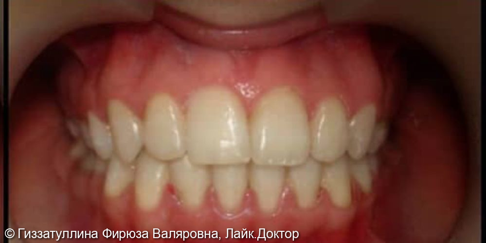 Исправление положения зубов в челюсти с помощью брекет системы в Стоматологии NOVIKOVSKI - фото №2