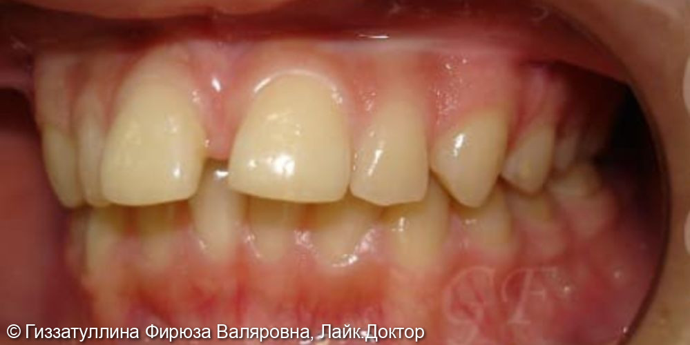 Исправление положения зубов в челюсти с помощью брекет системы - фото №1