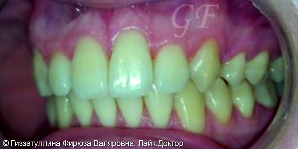 Исправление положения зубов в челюсти с помощью брекет системы - фото №2