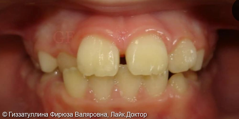 Исправление положения зубов в челюсти с помощью ортодонтических пластиночных аппаратов - фото №1