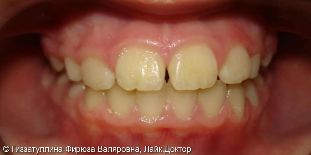 Исправление положения зубов в челюсти с помощью ортодонтических пластиночных аппаратов - фото №2