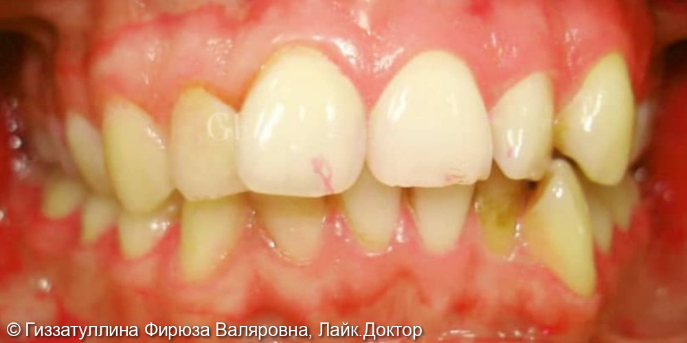 Исправление положения зубов в челюсти - фото №1