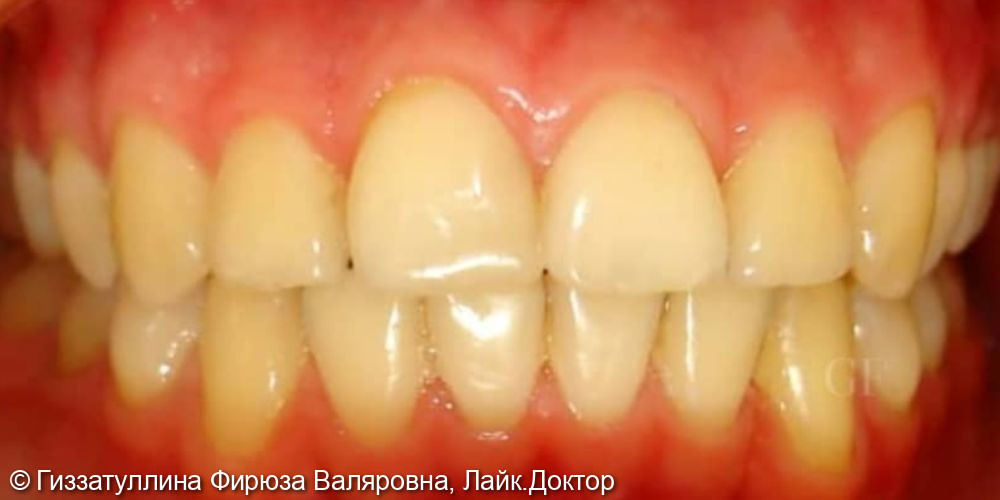 Исправление положения зубов в челюсти - фото №2