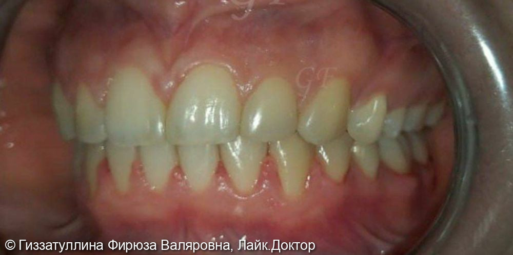 Исправление положения зубов - фото №2