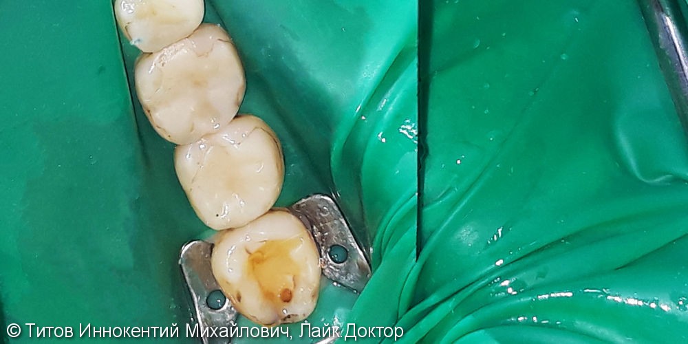 Лечение и реставрация четырех зубов фотополимером Filtek - фото №1