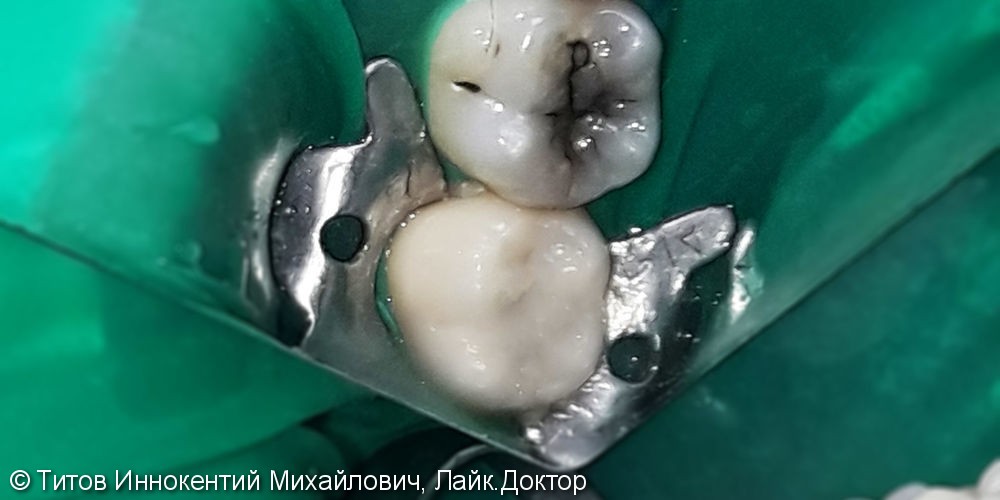 Лечение и реставрация зуба №46 фотополимером Filtek - фото №1