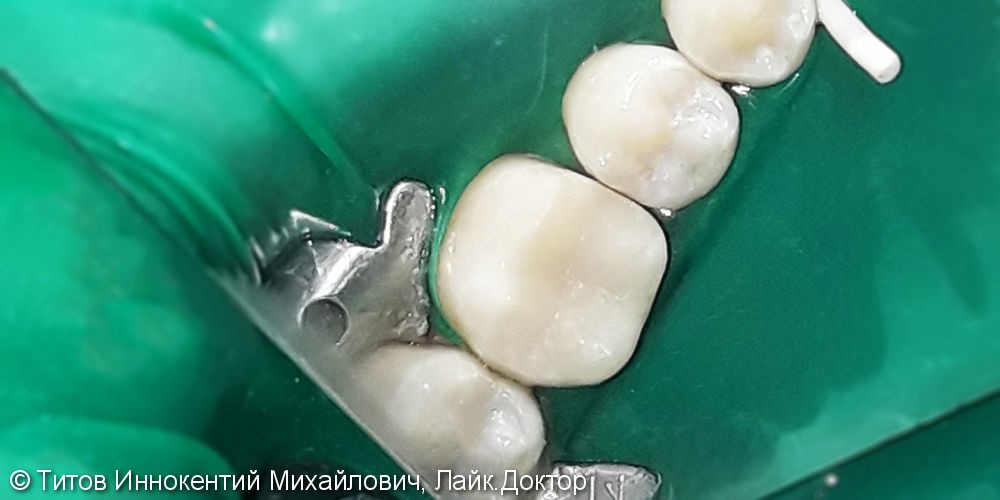 Лечение и реставрация зуба №46 фотополимером Filtek - фото №3