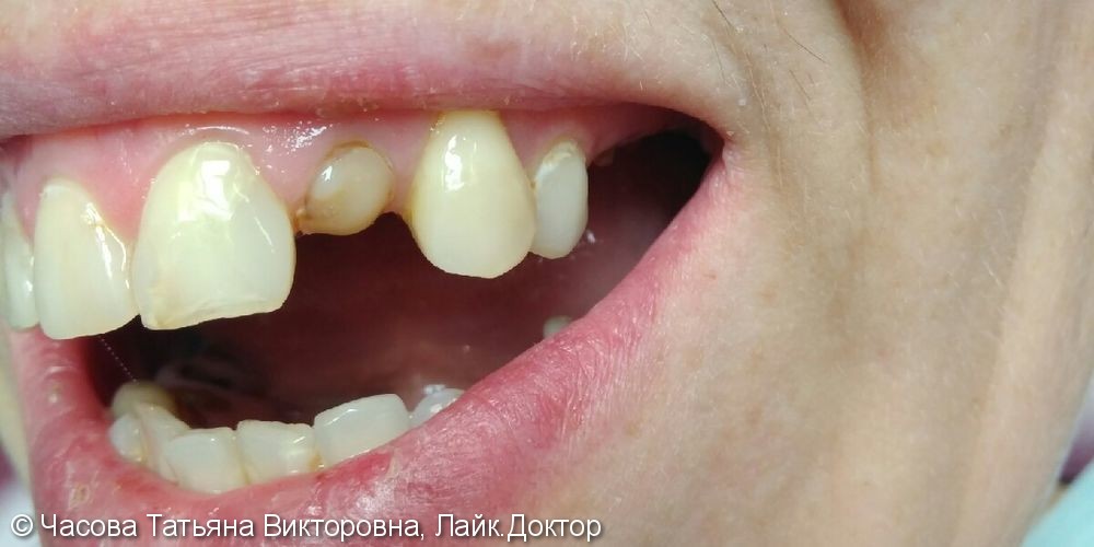 Восстановление зуба 22 металлокерамической коронкой - фото №1