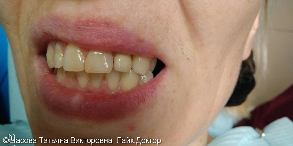 Восстановление зуба 22 металлокерамической коронкой - фото №2