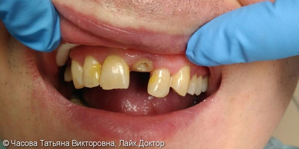 Восстановление 21 зуба - фото №1