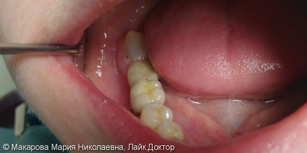 Восстановление дефекта 46, 47 зубов имплантатами с металлокерамическими коронками. - фото №2