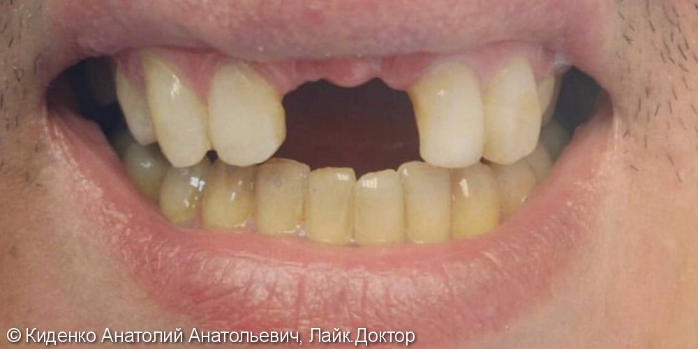 Протезирование двух передних зубов - фото №1