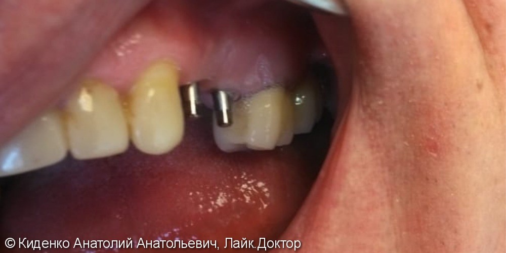 Протезирование зубов металлокерамическими коронками, до и после - фото №1