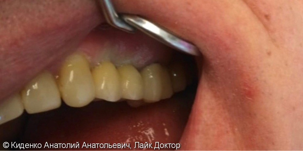 Протезирование зубов металлокерамическими коронками, до и после - фото №2